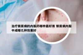 治疗银屑病的内服药哪种最好用 银屑病内服中成哪几种效果好