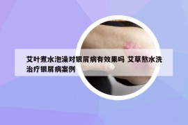 艾叶煮水泡澡对银屑病有效果吗 艾草熬水洗治疗银屑病案例