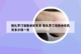 他扎罗汀倍他米松乳膏 他扎罗汀倍他米松乳膏多少钱一支