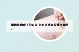 副银屑病留下的白斑 副银屑病会长满全身吗?