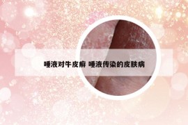 唾液对牛皮癣 唾液传染的皮肤病