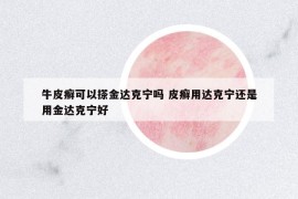 牛皮癣可以搽金达克宁吗 皮癣用达克宁还是用金达克宁好