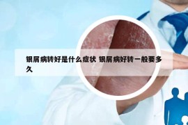 银屑病转好是什么症状 银屑病好转一般要多久