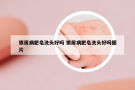 银屑病肥皂洗头好吗 银屑病肥皂洗头好吗图片
