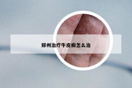 郑州治疗牛皮癣怎么治