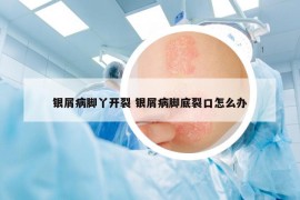 银屑病脚丫开裂 银屑病脚底裂口怎么办