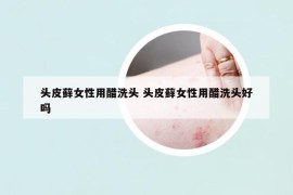 头皮藓女性用醋洗头 头皮藓女性用醋洗头好吗