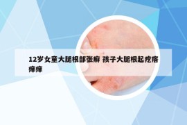 12岁女童大腿根部张癣 孩子大腿根起疙瘩痒痒
