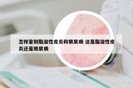 怎样鉴别脂溢性皮炎和银屑病 这是脂溢性皮炎还是银屑病
