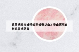 银屑病能治好吗效率长春华山3 华山医院自制银屑病药膏