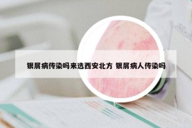 银屑病传染吗来选西安北方 银屑病人传染吗