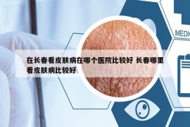 在长春看皮肤病在哪个医院比较好 长春哪里看皮肤病比较好
