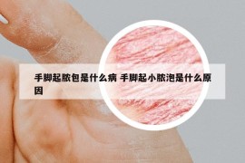 手脚起脓包是什么病 手脚起小脓泡是什么原因