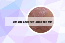 副银屑病多久能痊愈 副银屑病自愈吧
