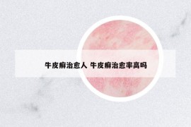 牛皮癣治愈人 牛皮癣治愈率高吗