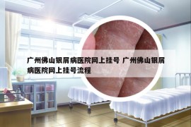 广州佛山银屑病医院网上挂号 广州佛山银屑病医院网上挂号流程