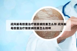 疏风解毒胶囊治疗银屑病效果怎么样 疏风解毒胶囊治疗银屑病效果怎么样啊