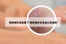 银屑病长耳朵里了 银屑病长在耳道口耳朵疼