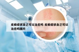 皮癣症状自己可以治愈吗 皮癣症状自己可以治愈吗图片