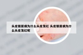 头皮银屑病为什么头皮发红 头皮银屑病为什么头皮发红呢