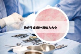 治疗牛皮癣外用偏方大全
