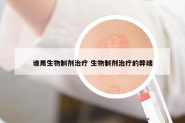 谁用生物制剂治疗 生物制剂治疗的弊端