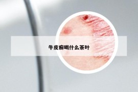 牛皮癣喝什么茶叶