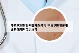 牛皮肤癣会影响全身酸痛吗 牛皮肤癣会影响全身酸痛吗怎么治疗