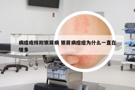 病痘疮样附银屑病 银屑病痘痘为什么一直在增多