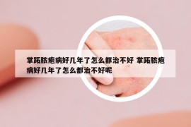 掌跖脓疱病好几年了怎么都治不好 掌跖脓疱病好几年了怎么都治不好呢