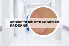 每天洗澡为什么长癣 为什么每天洗澡后皮肤都会起很多疙瘩