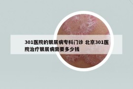 301医院的银屑病专科门诊 北京301医院治疗银屑病需要多少钱