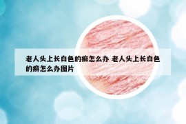 老人头上长白色的癣怎么办 老人头上长白色的癣怎么办图片