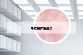 牛皮癣严重感染