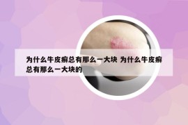 为什么牛皮癣总有那么一大块 为什么牛皮癣总有那么一大块的