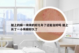 腿上的癣一块块的好几年了还能治好吗 腿上长了一小块癣好久了