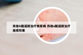 异维A酸凝胶治疗银屑病 异维a酸凝胶治疗痤疮效果
