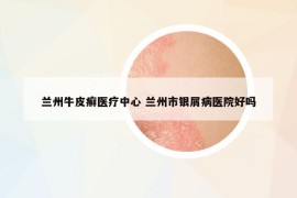 兰州牛皮癣医疗中心 兰州市银屑病医院好吗