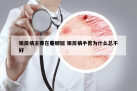 银屑病主要在胳膊腿 银屑病手臂为什么总不好