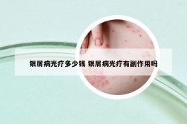 银屑病光疗多少钱 银屑病光疗有副作用吗