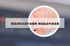 绿豆汤可以治牛皮藓吗 绿豆能治牛皮皮癣