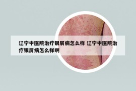 辽宁中医院治疗银屑病怎么样 辽宁中医院治疗银屑病怎么样啊