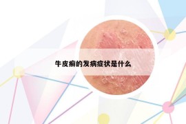 牛皮癣的发病症状是什么