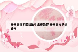 秦皇岛哪家医院治牛皮癣最好 秦皇岛皮肤病诊所