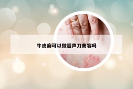 牛皮癣可以做超声刀美容吗