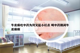 牛皮癣吃中药为何又起小红点 喝中药期间牛皮癣痒