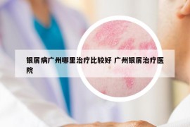 银屑病广州哪里治疗比较好 广州银屑治疗医院