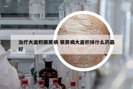 治疗大面积银屑病 银屑病大面积抹什么药最好