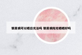 银屑病可以晒日光浴吗 银屑病阳光晒晒好吗