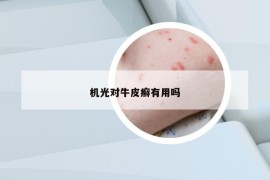 机光对牛皮癣有用吗